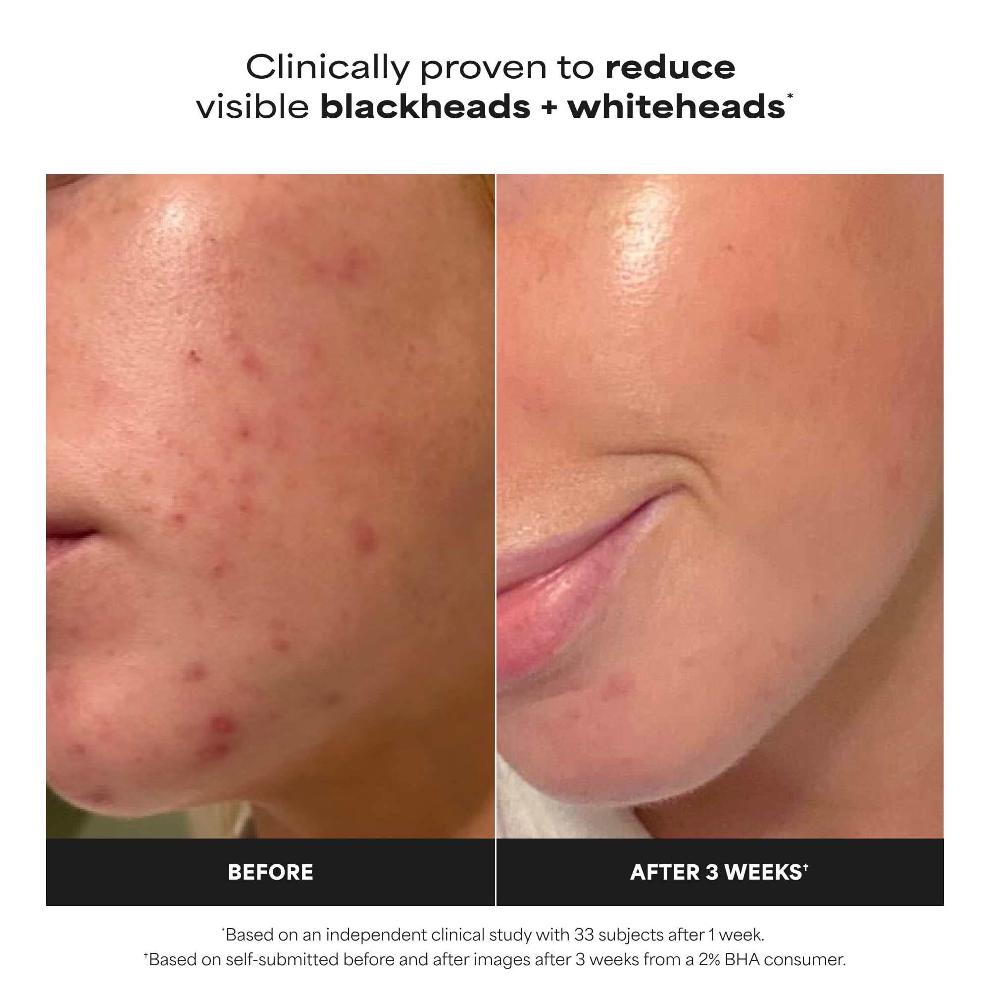 Paula’s Choice 2% BHA Liquid Exfoliant for Clearer Skin