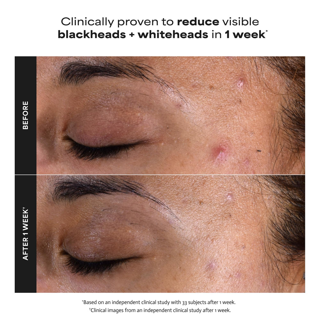 Paula’s Choice 2% BHA Liquid Exfoliant for Clearer Skin